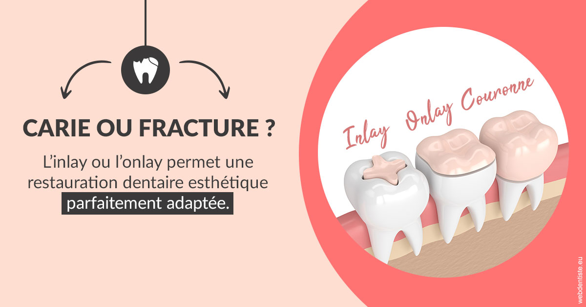 https://www.dr-grenard-orthodontie-gournay.fr/T2 2023 - Carie ou fracture 2
