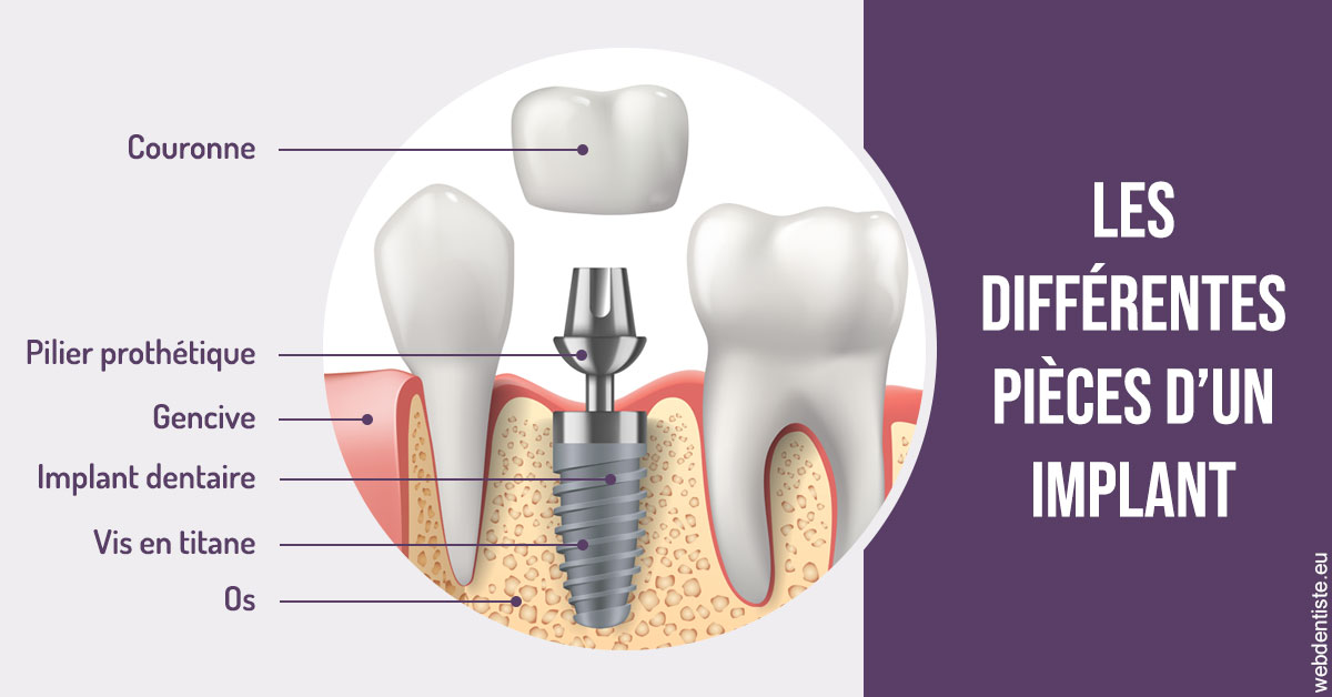https://www.dr-grenard-orthodontie-gournay.fr/Les différentes pièces d’un implant 2