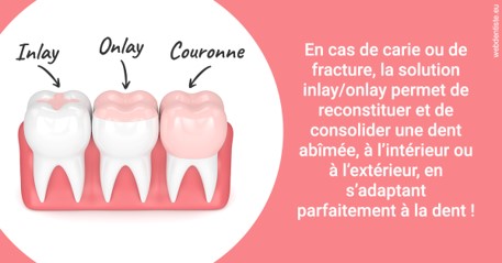 https://www.dr-grenard-orthodontie-gournay.fr/L'INLAY ou l'ONLAY 2