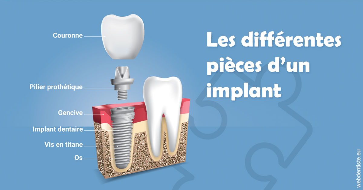 https://www.dr-grenard-orthodontie-gournay.fr/Les différentes pièces d’un implant 1